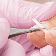Toenail Gel, Bracing & Reconstruction