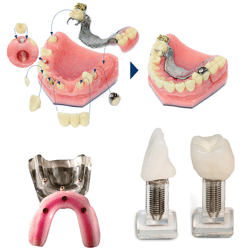 Implant & Overdenture Models